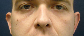 Chicago Otoplasty Surgery